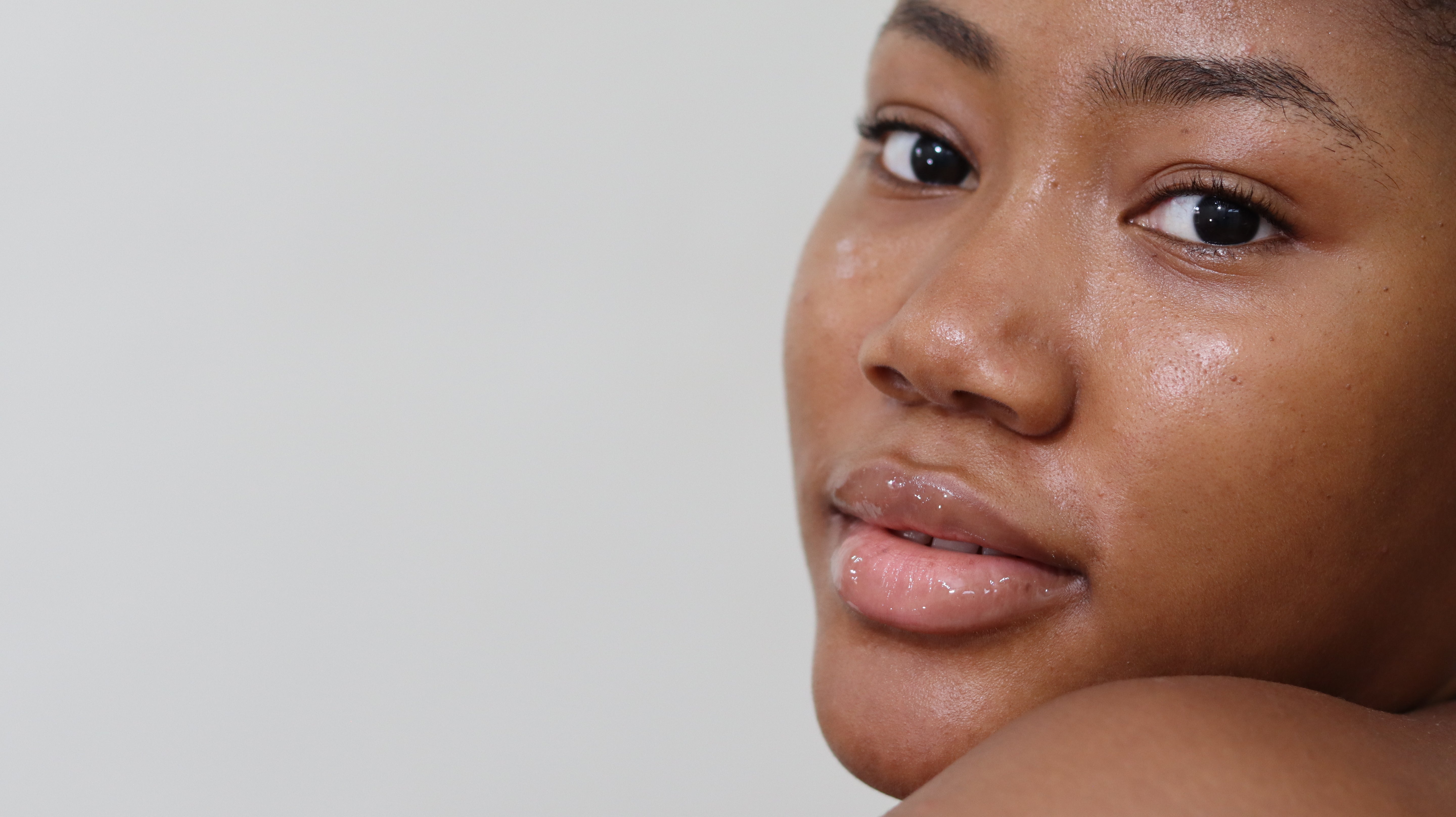 Hyperpigmentation & Discoloration