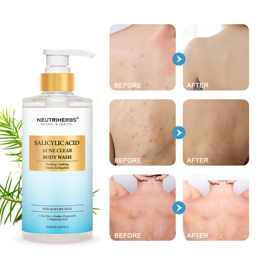 Salicylic Acid Body Wash For Acne Prone Skin -500ml