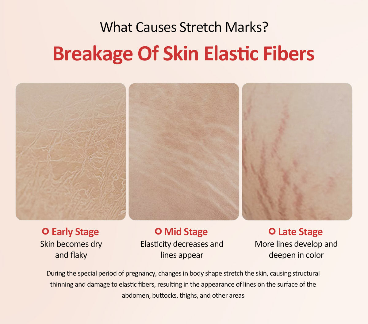 Intensive Stretch Mark Cream For  Smoother Resilient Skin