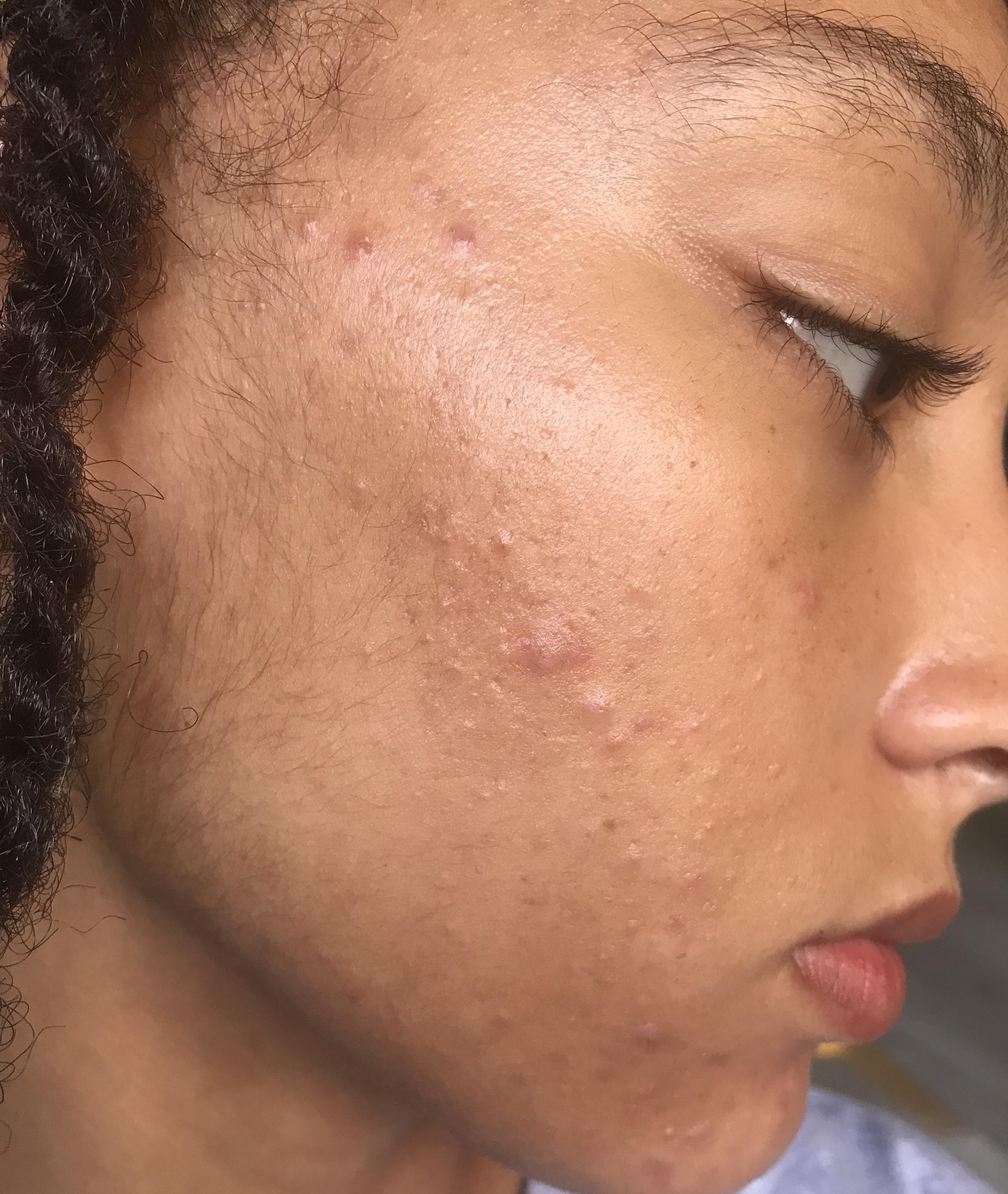 How To Get Rid Of Acne Breakouts A Complete Guide To Clear Skin Neutriherbs Nigeria pic