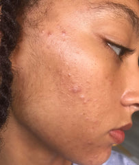 How To Get Rid Of Acne Breakouts: A Complete Guide To Clear Skin