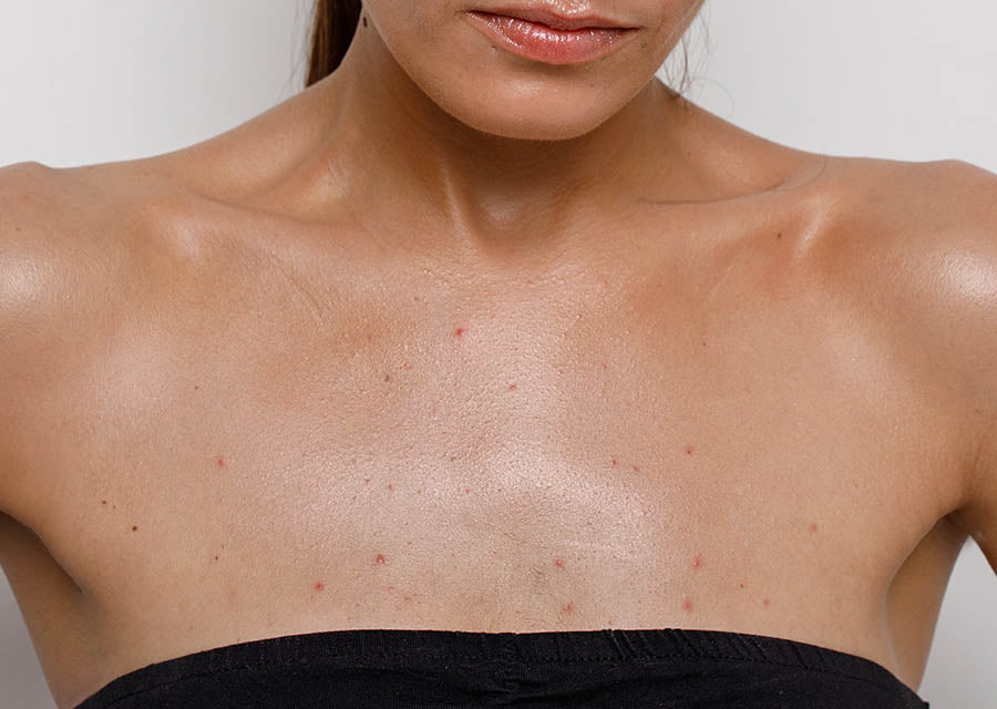 How To Get Rid Of Body Acne & Breakouts